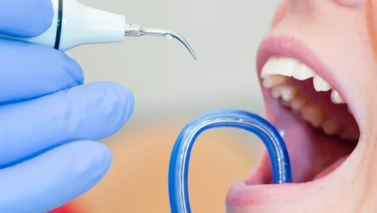 Tandsteen verwijderen